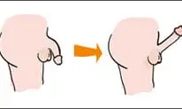erection